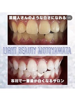 ライトビューティー 本八幡店(LIGHT BEAUTY)/スタッフの歯です♪