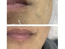 シェルナ(CIELNA)/しっかり脱毛！