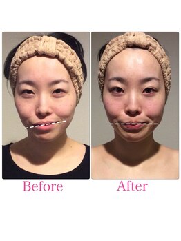 TKC 東京小顔センター五反田店/ビフォーアフター【ゆがみ改善】