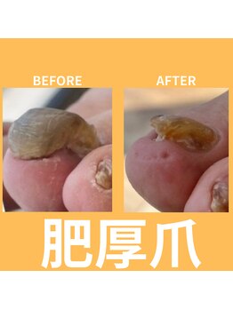 ウォーク イオンスタイル東淀川(WALK)/厚くなった爪/肥厚爪