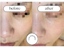 ユヌランコント 岐阜店(Une rencontre)/ハーブピーリング