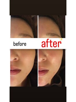 ラブランフェアリー/むくみケアで小顔