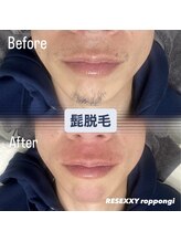 リゼクシー INTERNATIONAL麻布十番 六本木(RESEXXY)/髭の脱毛