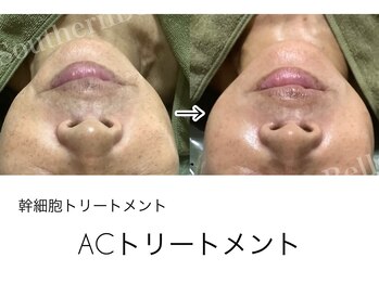 サザンベル(Southern Belle)/リアボーテACトリートメント