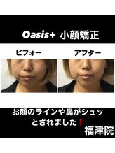 整体院オアシス イオンモール福津店(OASIS)/小顔施術【ビフォーアフタ―】