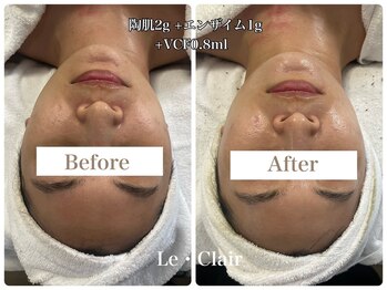 スキンセラピーサロン ル クレール(Le Clair)/Before→After
