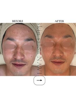 ナビ(NAVI)/毛穴／毛穴の黒ずみ／毛穴詰まり