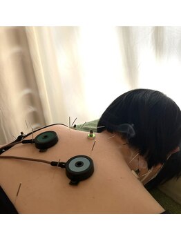久心宝鍼灸院/お身体の鍼