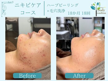 ボディコンディション/ハーブピーリング/毛穴洗浄/小顔