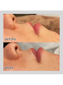 アデル 久留米(ADEL)/《全顔》口元ワックス