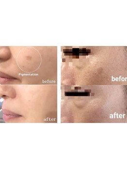 シミしわ改善！予防ケア