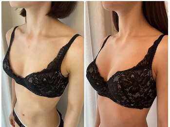 美バストアルファ(美bust α)/【バストアップ】症例