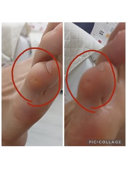 遊歩堂/小指上魚の目