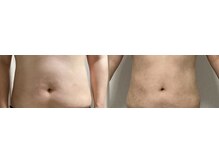 リラチル(relachill)/筋膜リリース（全身）