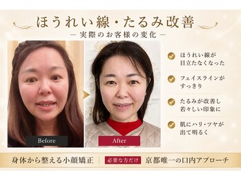 サロンチオリ 烏丸(Salon Chiori)の写真/40代50代の深いほうれい線・頬下がり。老け見え印象をくつがえす本格たるみ改善。京都唯一の口内アプローチ