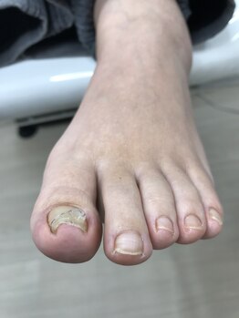 ドクターネイル爪革命 北千住店/巻き爪ケア