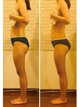 うつくし痩身 美サロン ゼットワン(Z-ONE)/メディセル１回　before　after