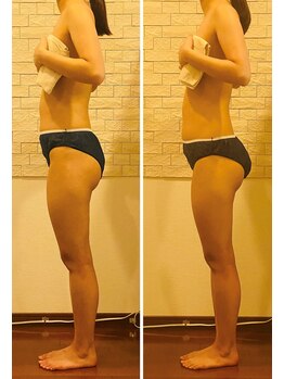 うつくし痩身 美サロン ゼットワン(Z-ONE)/メディセル１回　before　after