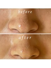 ルマエクレ(rmaecla)/毛穴ケア　カーボキシー　