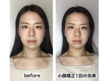 ビジュー(bijoux)/一度のビフォアフ１