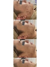 エスボーテ(sbeaute)/プラズマ+お悩み別美容液