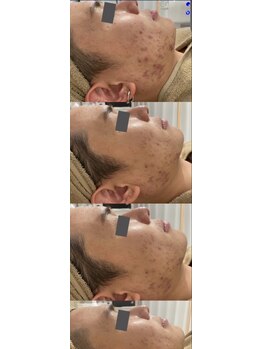 エスボーテ(sbeaute)/プラズマ+お悩み別美容液