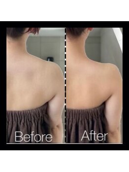 ラグラン銀座メディカルエステ 高輪ゲートウェイ店/【圧倒的人気】一撃級僧帽筋除去