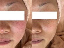 ミュー 栄本店(mieux)/肌トラブルの改善