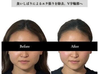 アロエベル(aloe Belle)/Before After（4回施術）