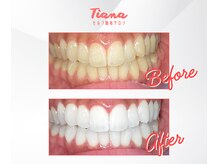 ティアナ(Tiana)/ホワイトニング　Before&After