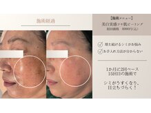 ピーロ(PiiiLO)/気になるシミが薄くなった!