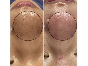 ビーアンドビー(B&B)/ハイドロコース