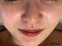 サロン ド エメ(salon de aimer)/【Before】本格エイジングケアに