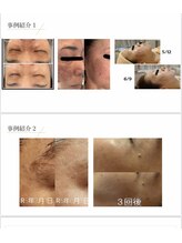 リラックス(Relax)/幹細胞培養液ーエクソソーム導入