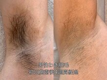 エクレ 柏店(EKURE)/メンズワキ脱毛