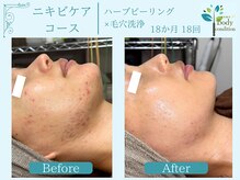 ボディコンディション/ハーブピーリング/毛穴洗浄/小顔