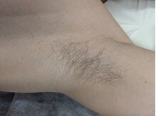 ブルーココア(BlueCocoa)/ワキ（毛量は少なめ）施術前