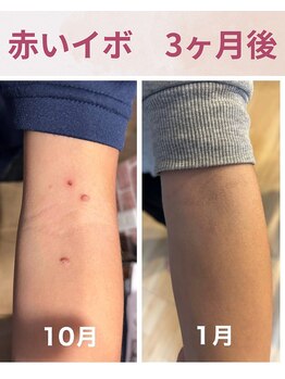 ララスマイル 鶴崎森町店/赤いポツポツが綺麗になりました