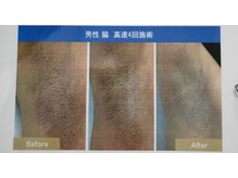 クローバー(clover)/わき脱毛