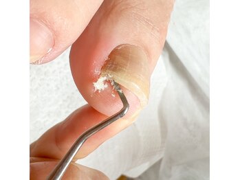 ハチネイルケア(hachi nailcare)の写真/〈フット角質ケア/フットネイルケア〉乾燥によるかかとのパックリひび割れ,歩き癖によるタコもお任せ
