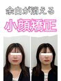 ラフテル鍼灸整骨院&nbsp;小顔矯正 施術例
