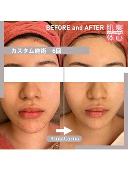 アンナカルナ(AnnaCarna)/不安定なお肌質改善もお任せ