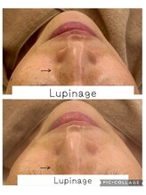 ルピナージュ(Lupinage)/【肌質改善】-たるみ/しみケア-