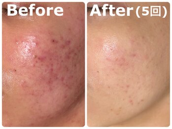 スイ 昭島店(Sui)/ハーブピーリング/ニキビケア