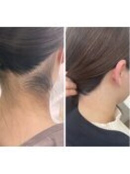 ミース 福岡本店/うなじ矯正◆ビフォーアフター