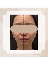 プティリッシュ(Petit Rishe)/EMS