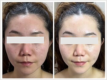 恵比寿脱毛 シーズ(She’s)/ソフトダーマ20代ビフォア