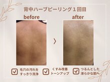 シロ(CHILO)/背中ハーブピーリング