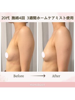 ミミバスト(mimibust)/バストアップBeforeAfter