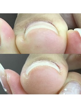 セラキュアネイル(Theracure nail)/巻き爪緩和